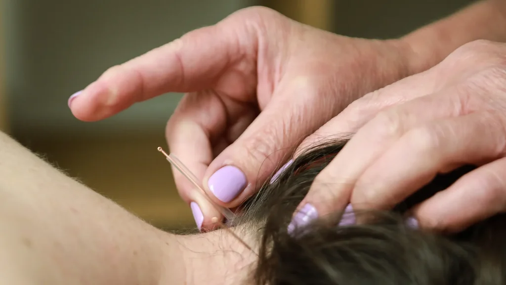 Person receiving acupuncture treatment at our clinic in Wendover